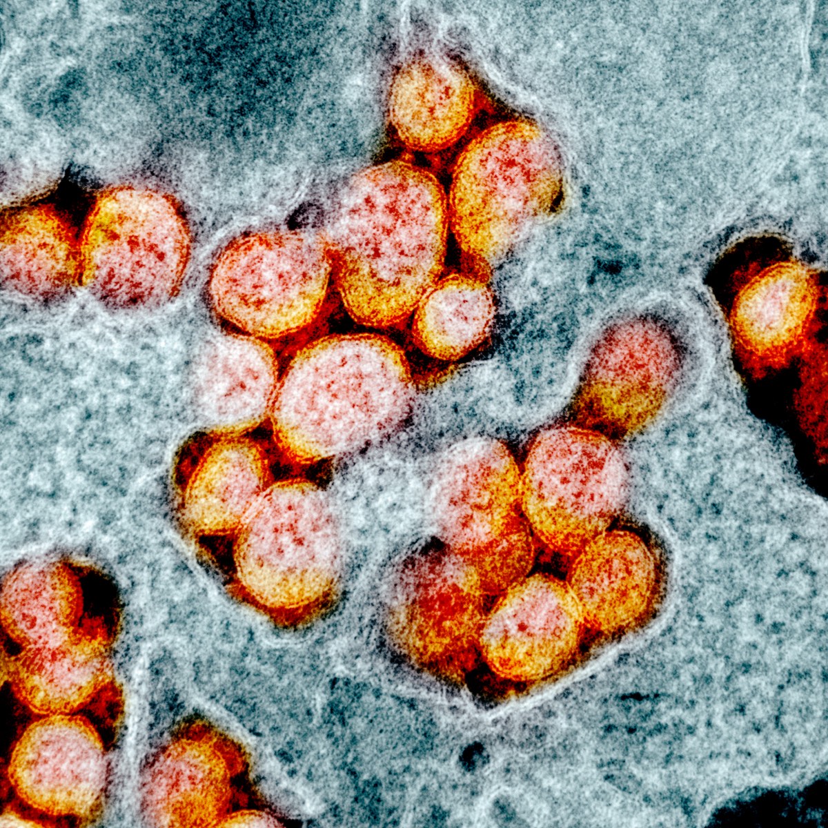 A colorized scanning electron micrograph of SARS-CoV-2 virus particles — small round virions with characteristic spike-protein crowns, photographed against a textured cellular surface, virus particles tinted yellow against a grey-blue background.
