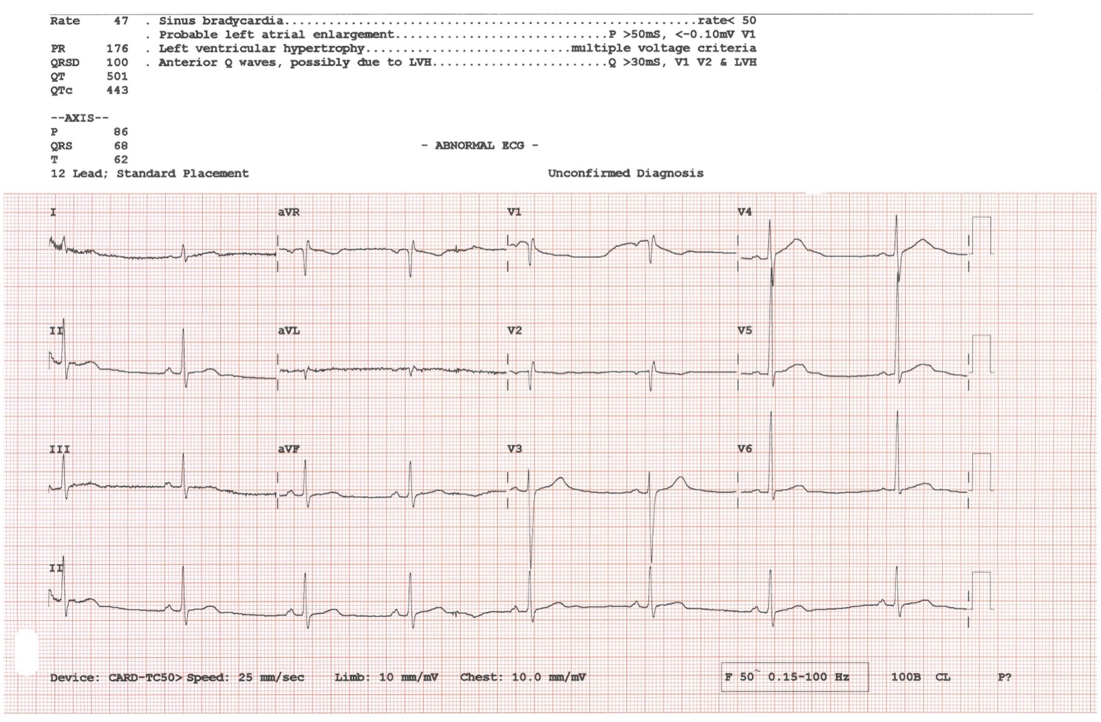 A twelve-lead electrocardiogram (ECG) printout, showing the repeating waveform traces of a heartbeat across multiple channels.